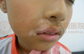 11岁男孩嘴角患白癜风4个月治愈